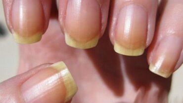 Yellow nails might be an alarming sign!