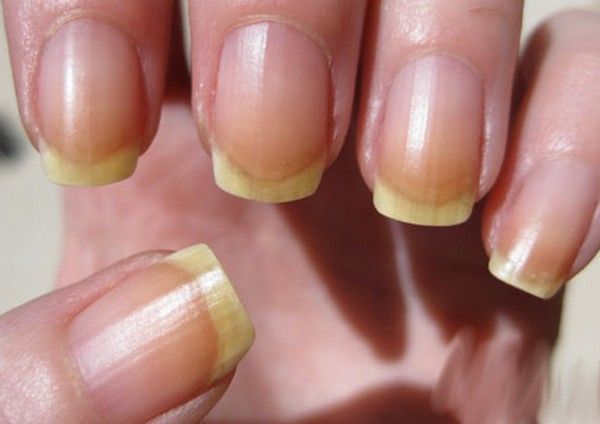 yellow-nails yellow-nails