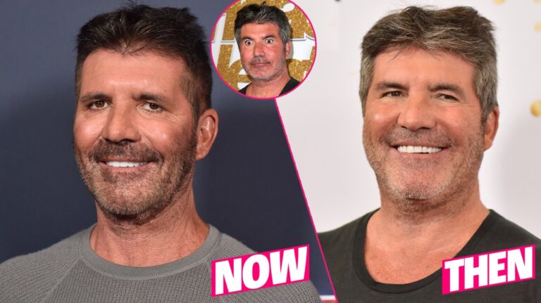 Simon-Cowell-Before-After-Plastic-Surgery-Photos-pp