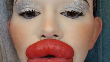 Woman with ‘world’s biggest lips’ is now splashing out on her cheekbones