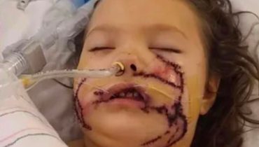 Girl, 6, attacked by dog has more than 1,000 stitches on her face after brutal injuries